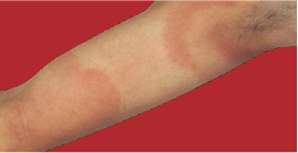 Immagine di un eritema da zecca